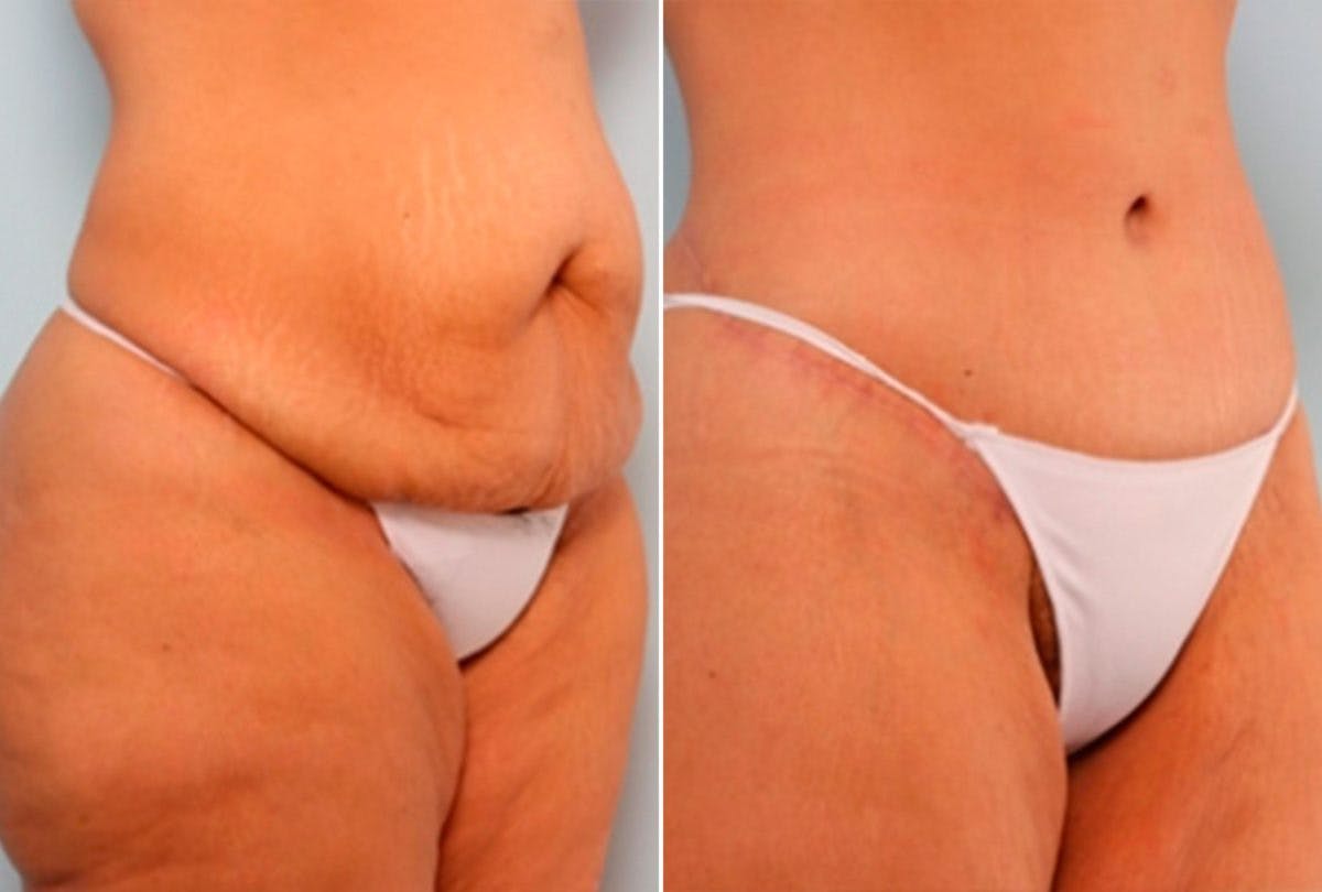 Body Lift Before & After Gallery - Patient 54881816 - Image 2