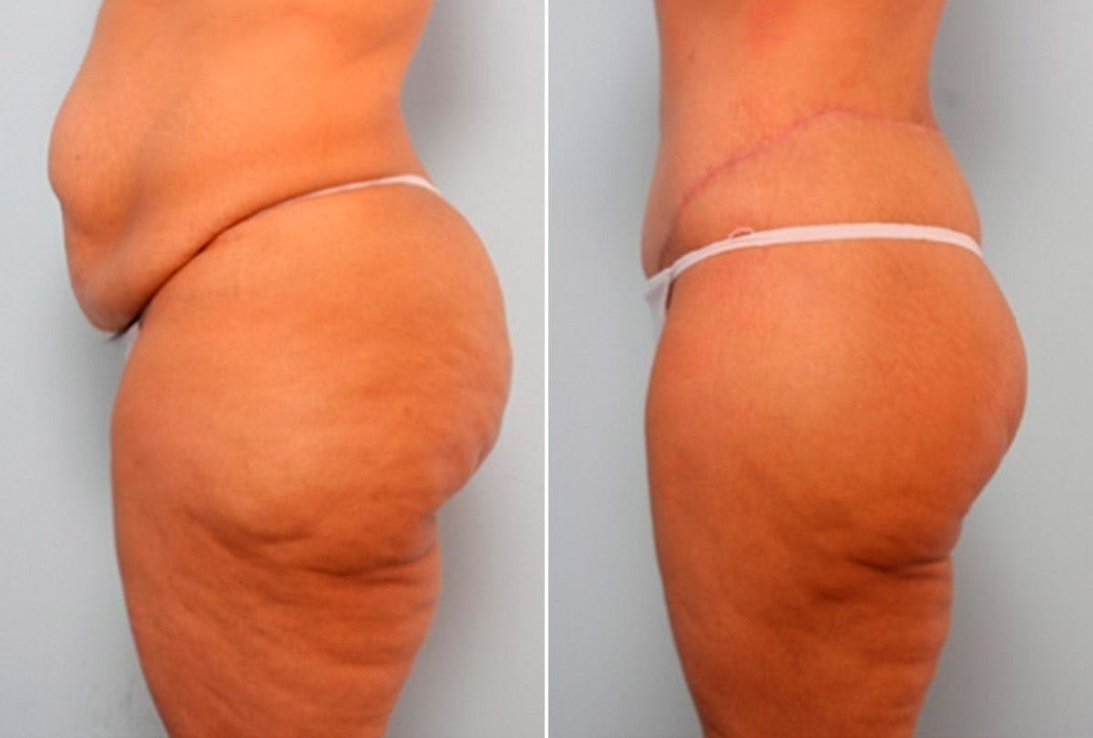 Body Lift Before & After Gallery - Patient 54881816 - Image 5
