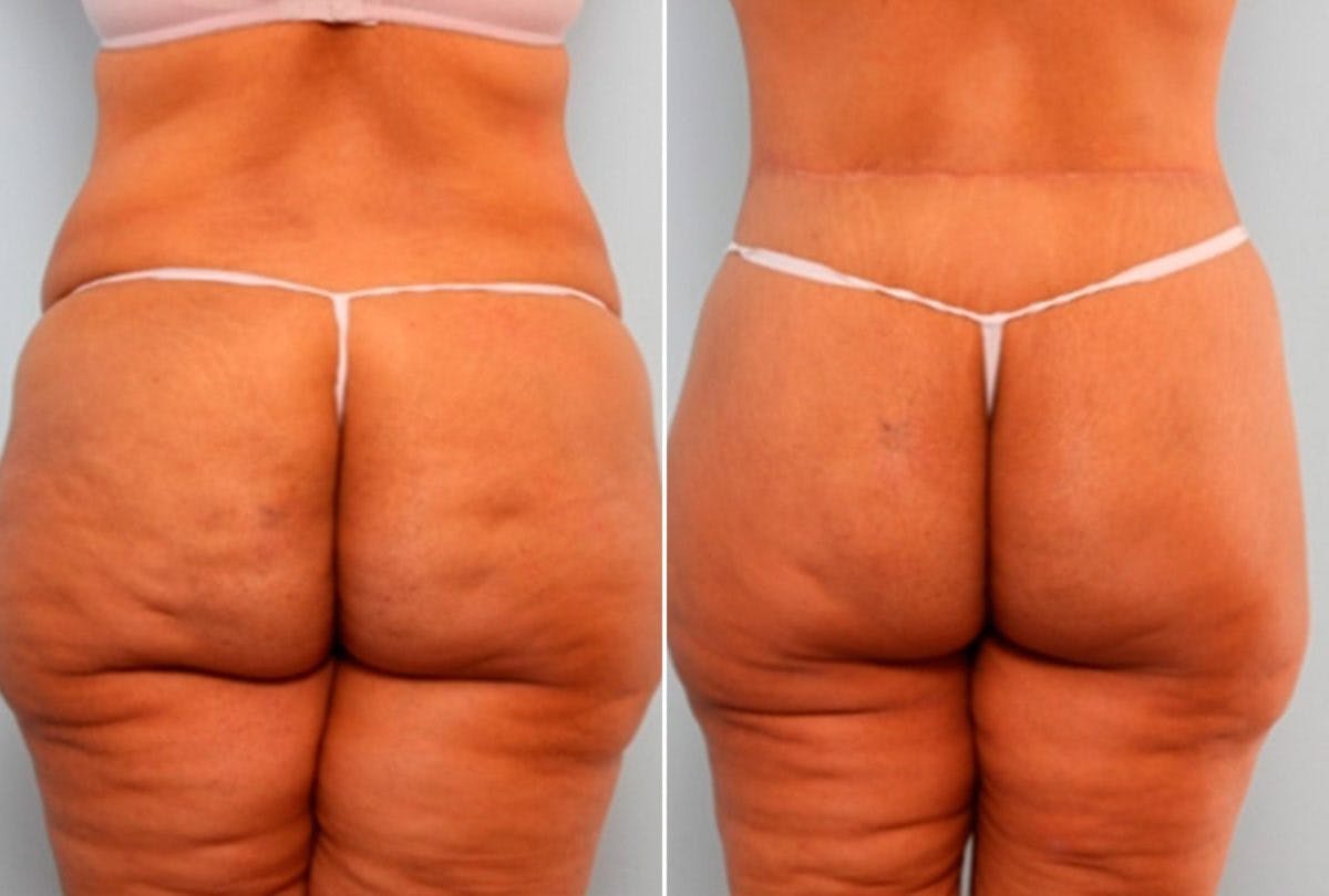 Body Lift Before & After Gallery - Patient 54881816 - Image 6