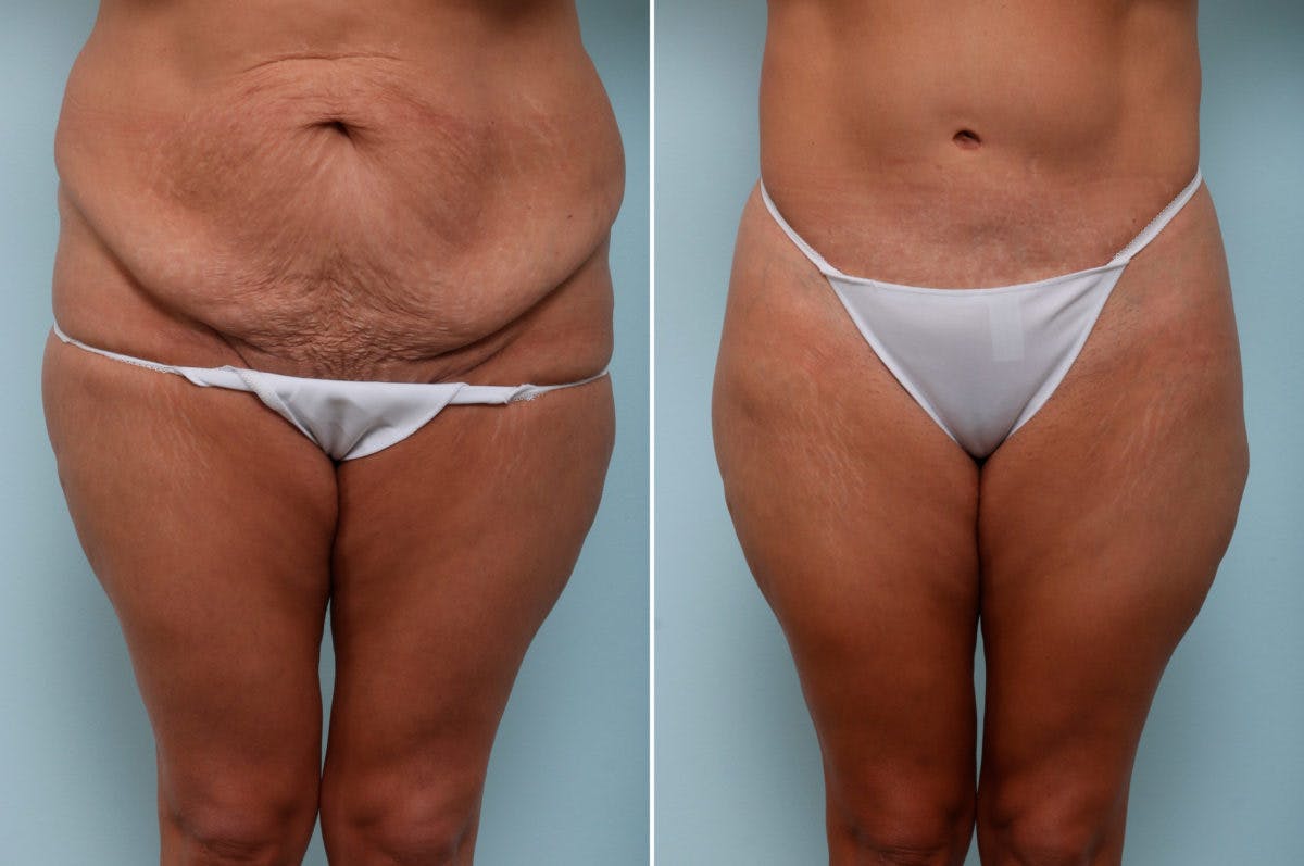 Body Lift Before & After Photo - Patient 54881819 - Image 1