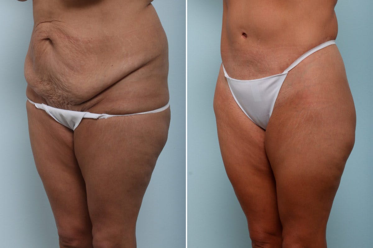 Body Lift Before & After Photo - Patient 54881819 - Image 4