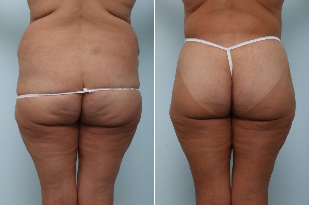 Body Lift Before & After Gallery - Patient 54881819 - Image 6