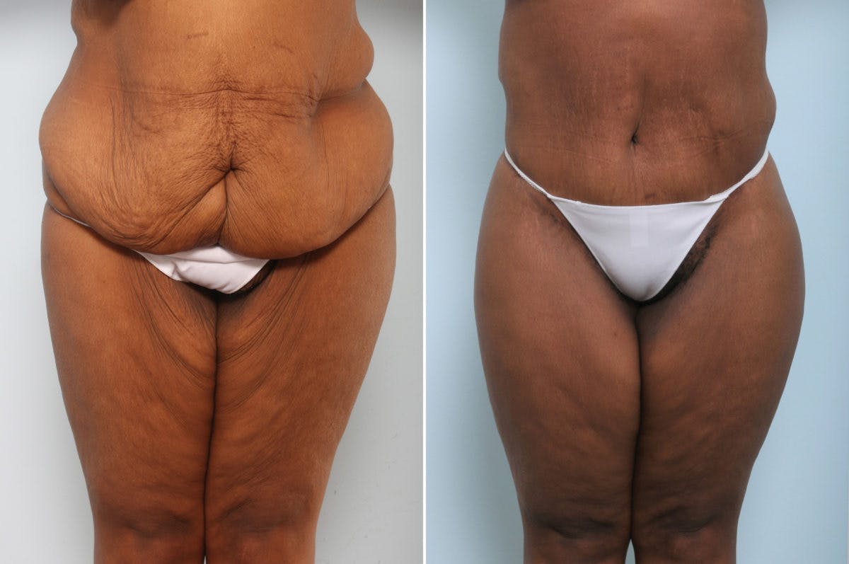 Body Lift Before & After Gallery - Patient 54881820 - Image 1