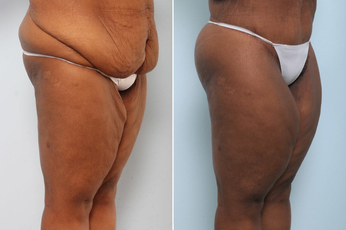 Body Lift Before & After Gallery - Patient 54881820 - Image 2