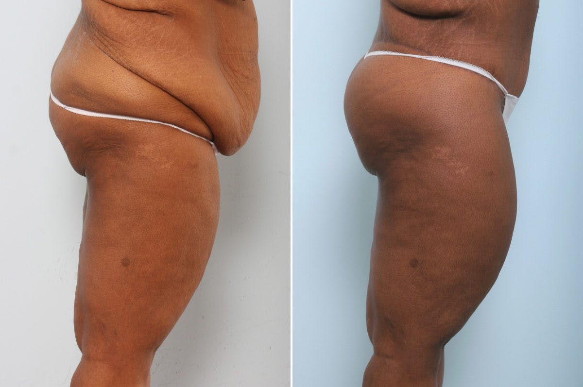 Body Lift Before & After Gallery - Patient 54881820 - Image 3