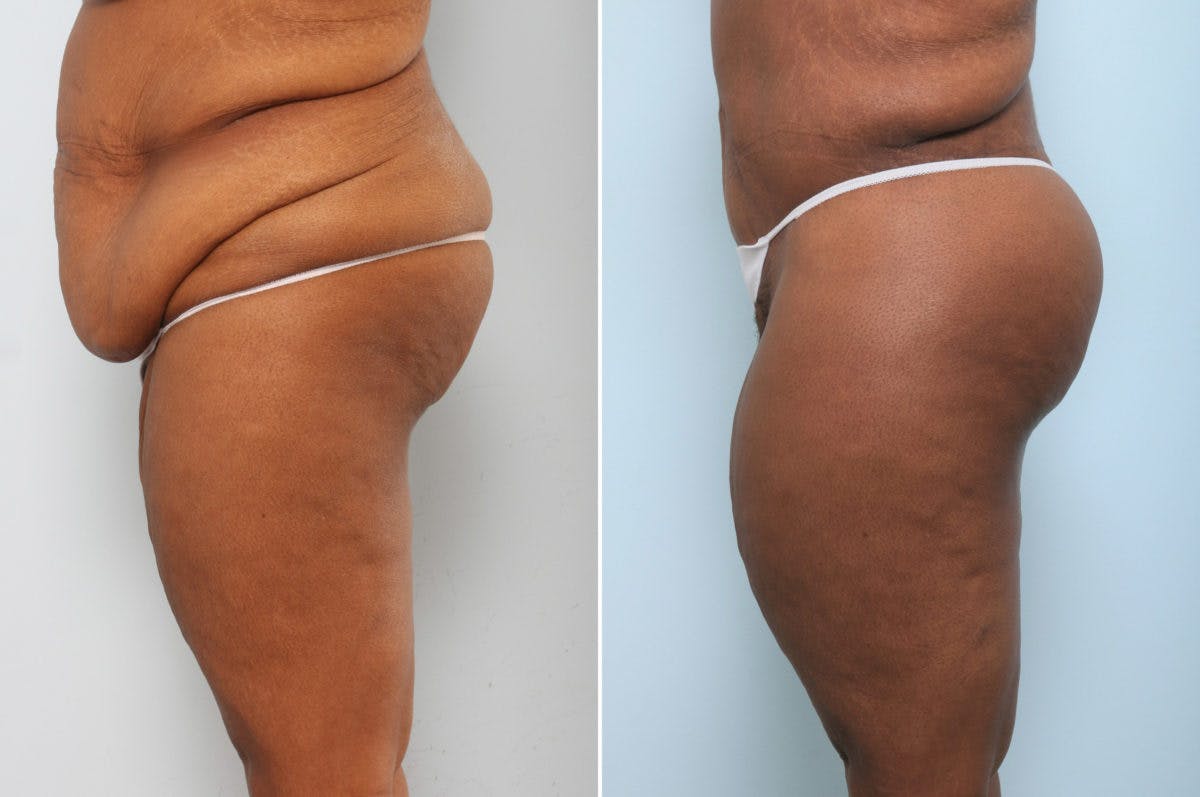 Body Lift Before & After Gallery - Patient 54881820 - Image 5