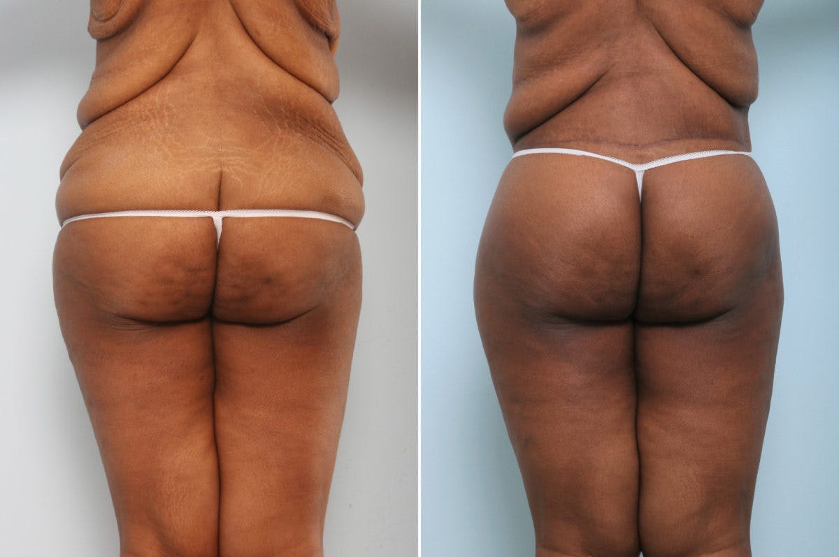 Body Lift Before & After Gallery - Patient 54881820 - Image 6