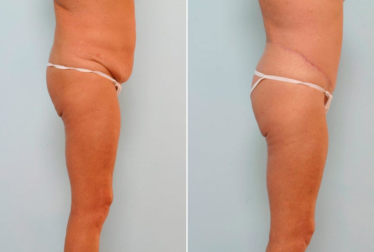 Body Lift Before & After Gallery - Patient 54881903 - Image 3