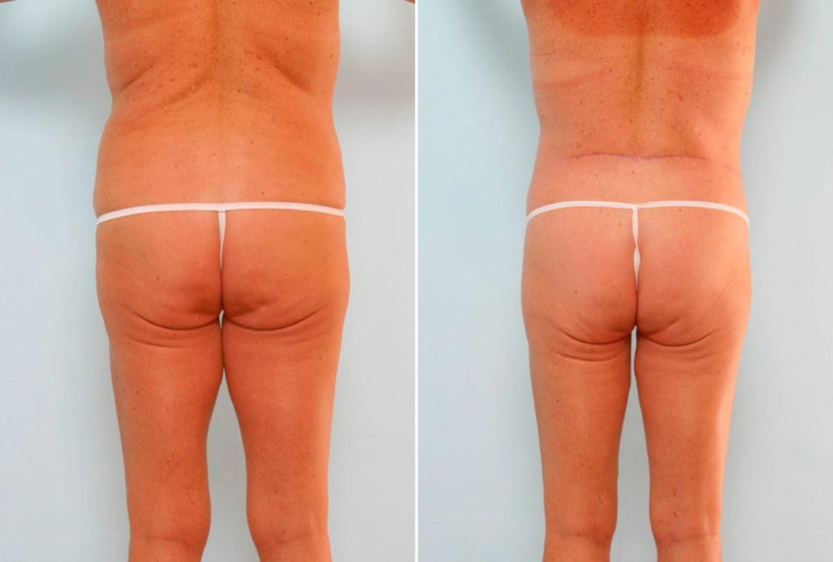 Body Lift Before & After Gallery - Patient 54881903 - Image 4