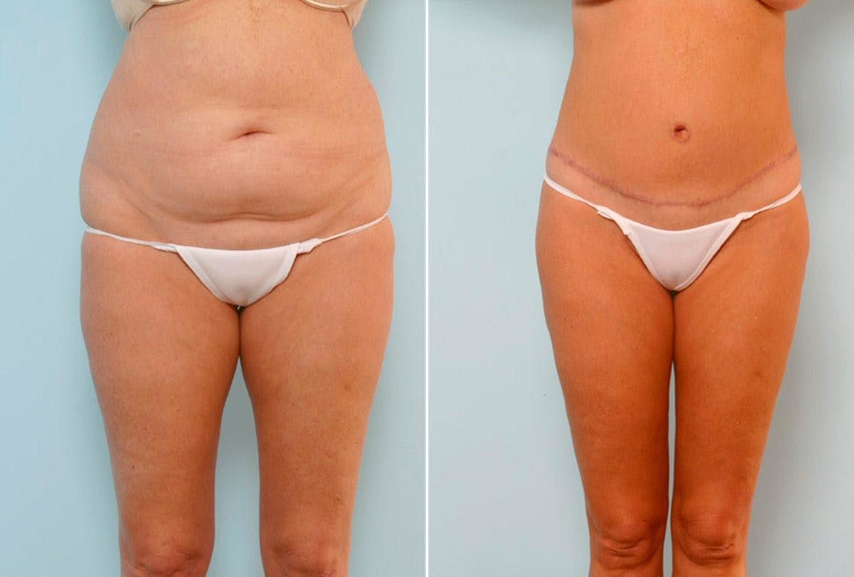 Body Lift Before & After Gallery - Patient 54881904 - Image 1