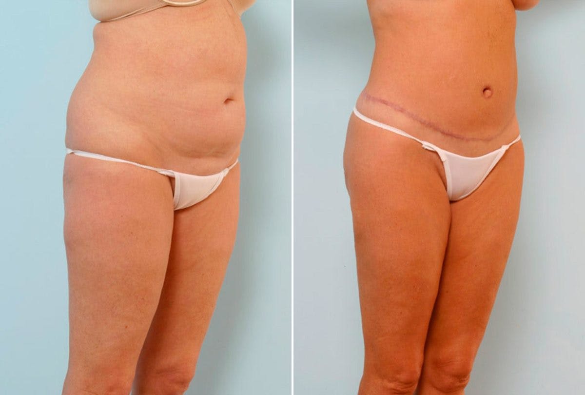 Body Lift Before & After Gallery - Patient 54881904 - Image 2