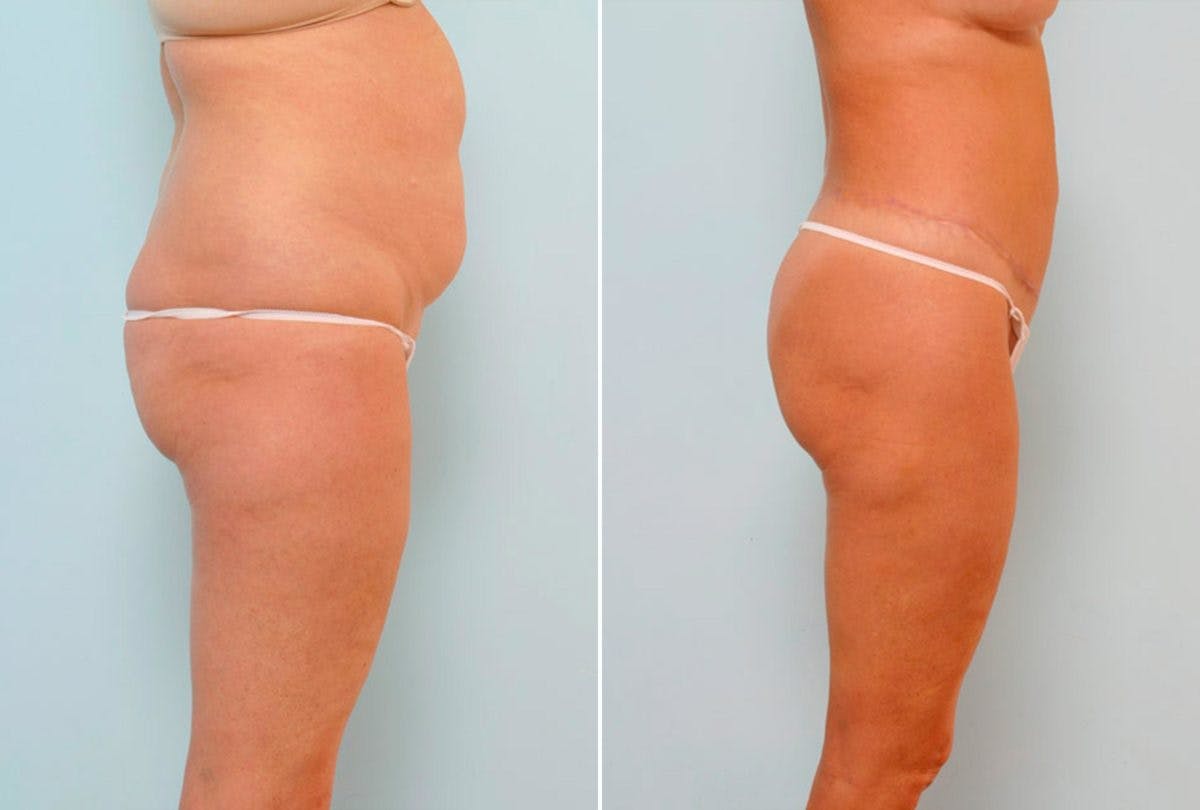 Body Lift Before & After Gallery - Patient 54881904 - Image 3