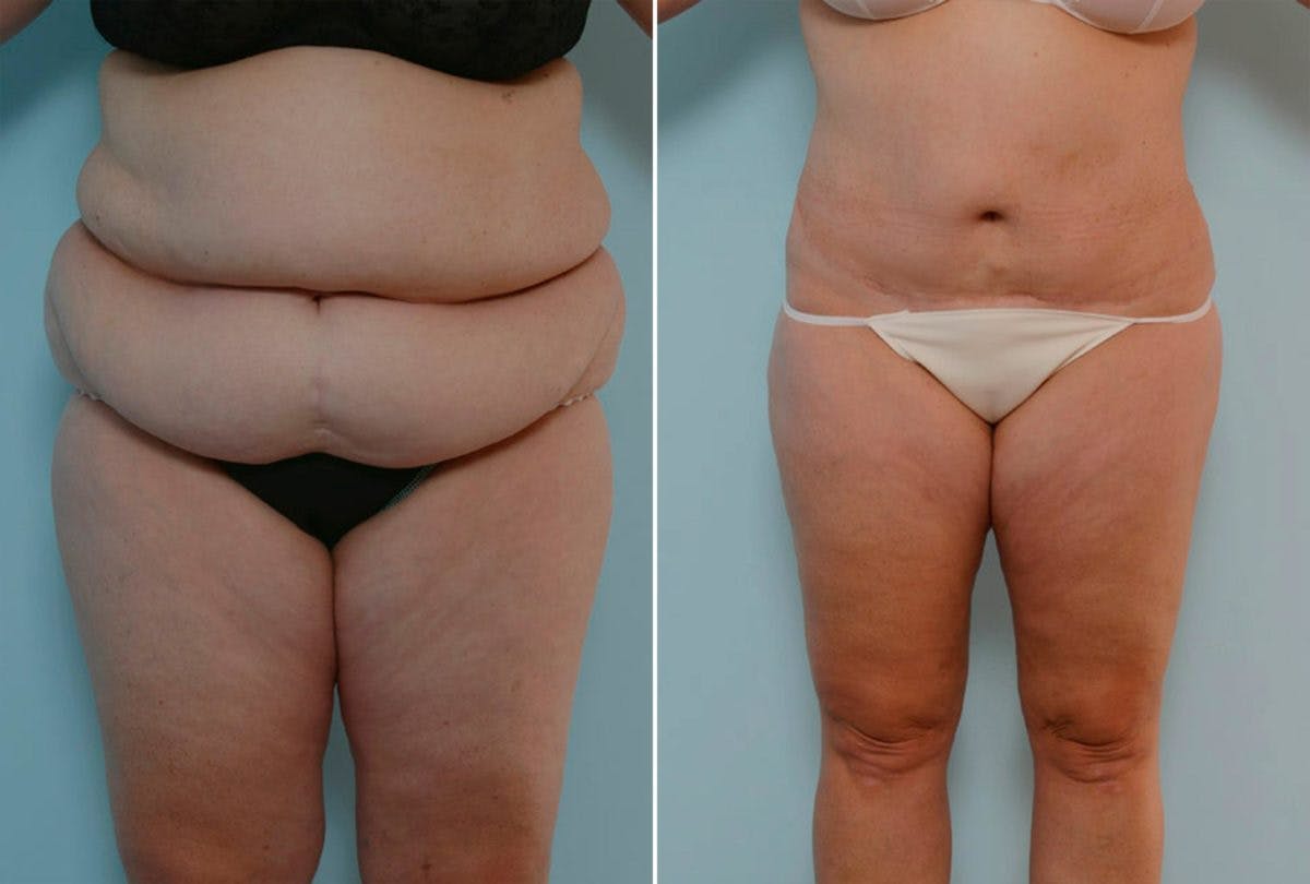 Body Lift Before & After Gallery - Patient 54881906 - Image 1