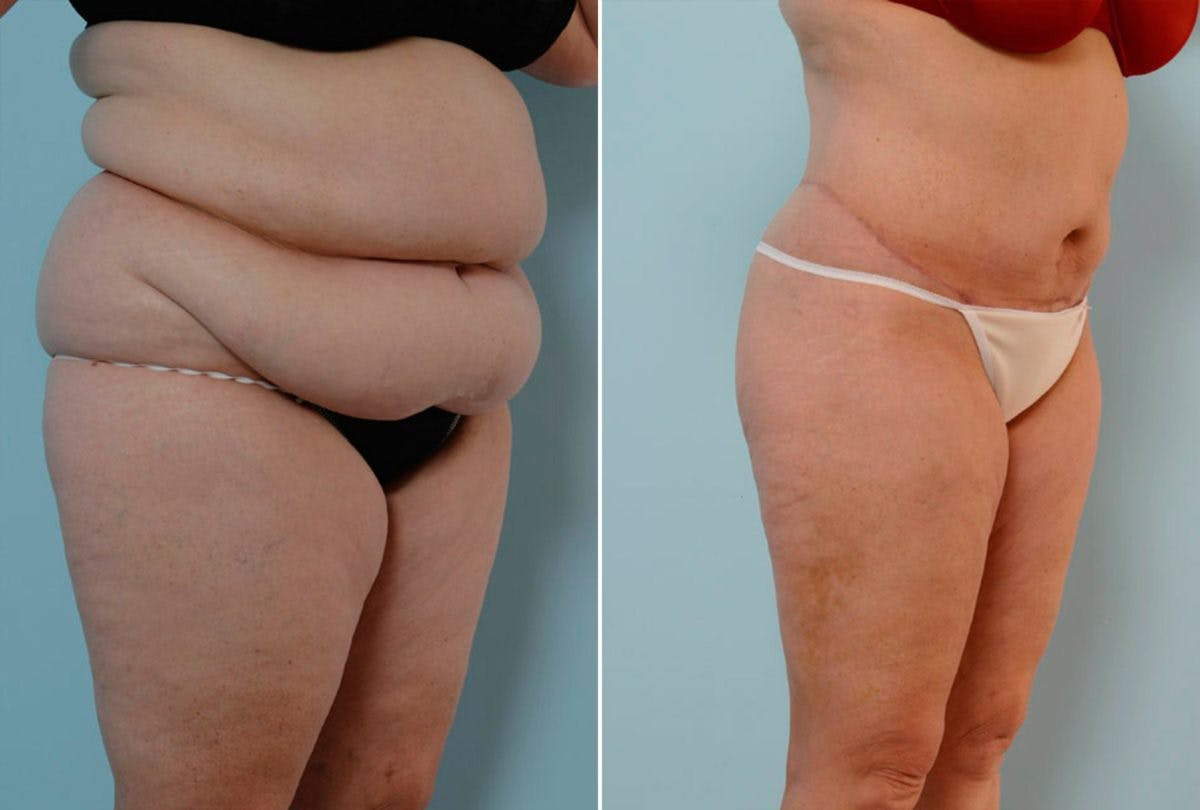 Body Lift Before & After Gallery - Patient 54881906 - Image 2