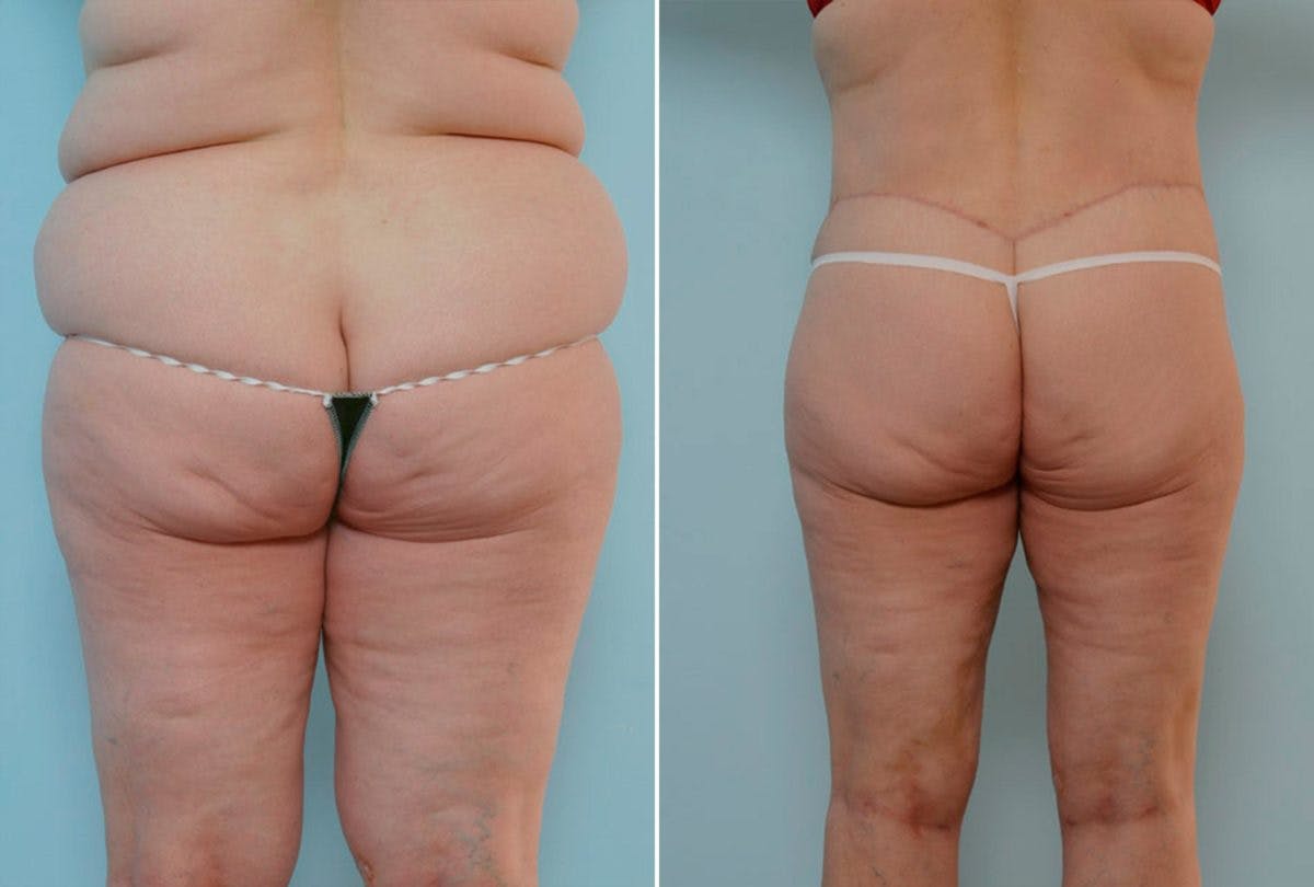 Body Lift Before & After Gallery - Patient 54881906 - Image 4