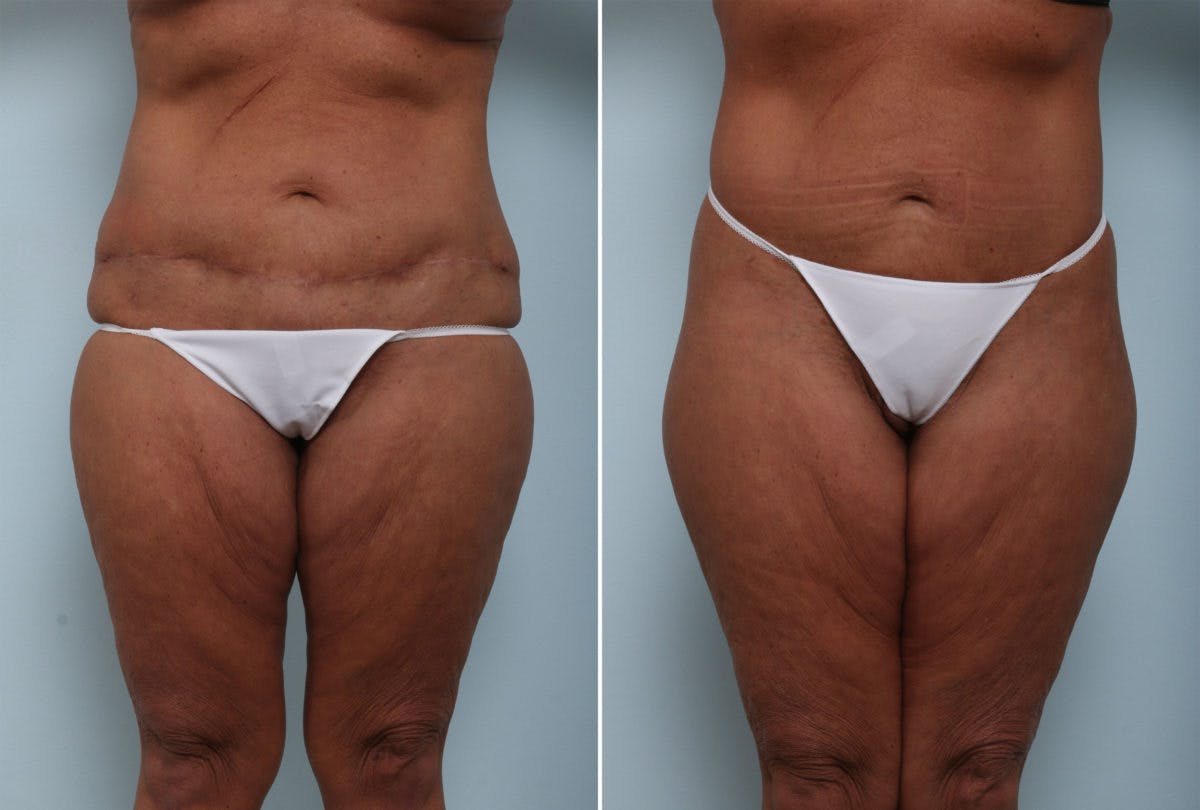 Body Lift Before & After Gallery - Patient 54881907 - Image 1
