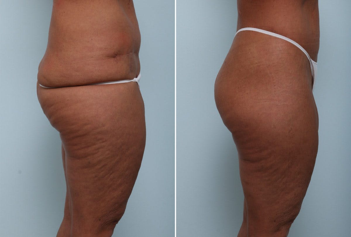 Body Lift Before & After Gallery - Patient 54881907 - Image 2