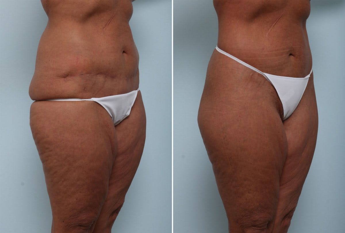 Body Lift Before & After Gallery - Patient 54881907 - Image 3