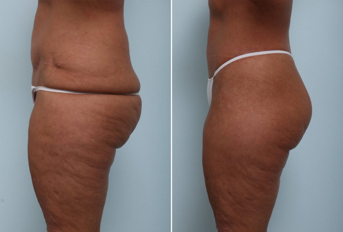 Body Lift Before & After Gallery - Patient 54881907 - Image 4