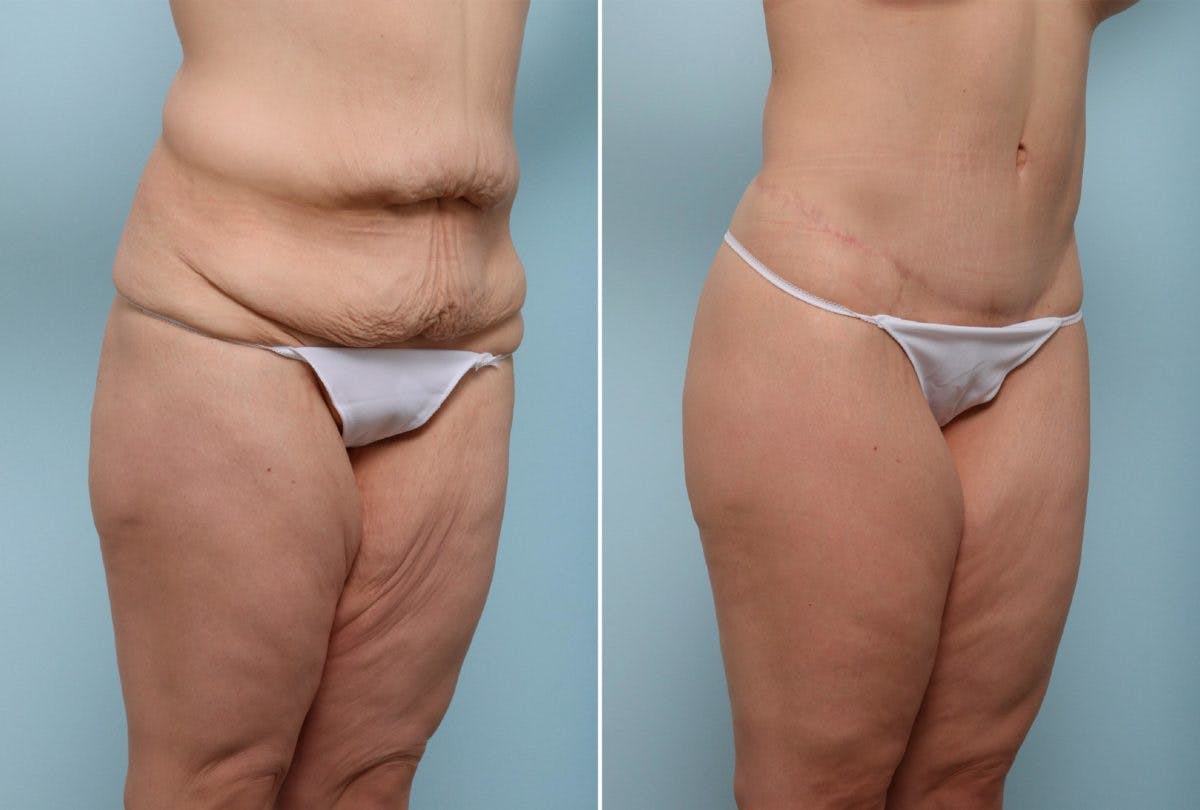 Body Lift Before & After Gallery - Patient 54881908 - Image 2