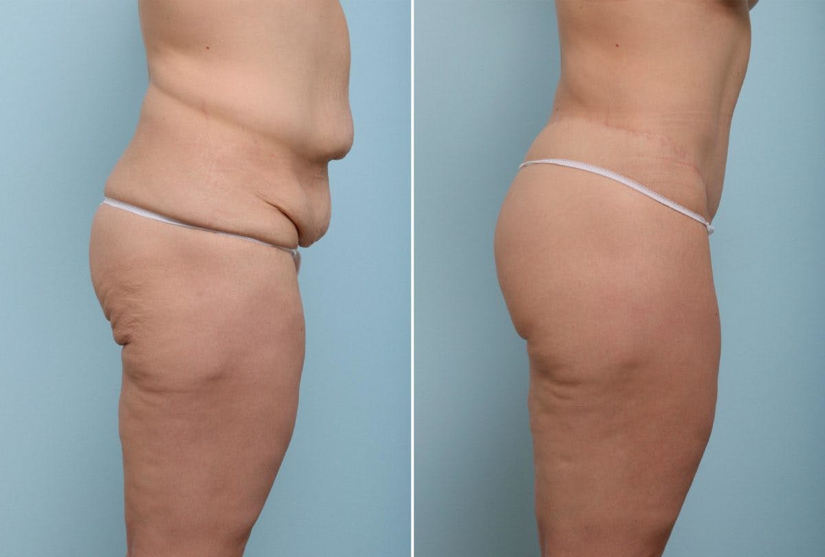 Body Lift Before & After Gallery - Patient 54881908 - Image 3