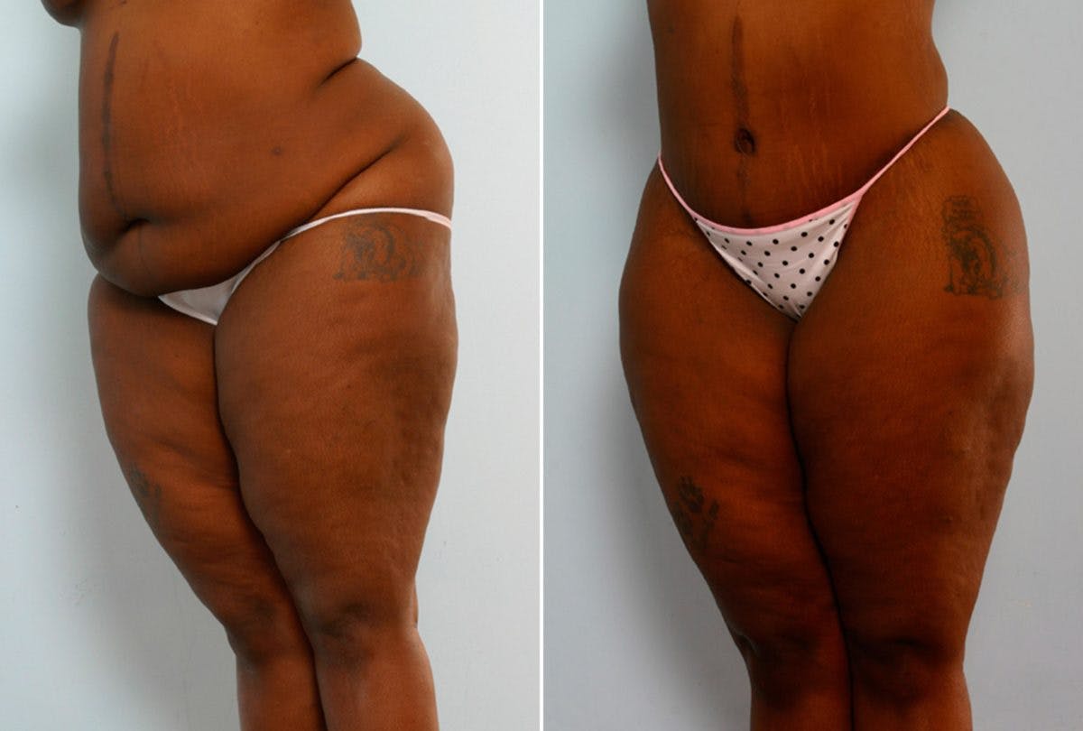 Body Lift Before & After Gallery - Patient 54881910 - Image 4