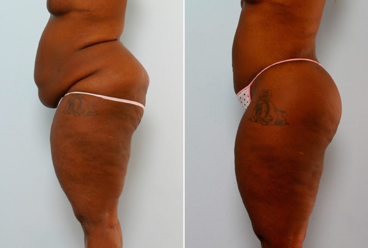 Body Lift Before & After Gallery - Patient 54881910 - Image 5