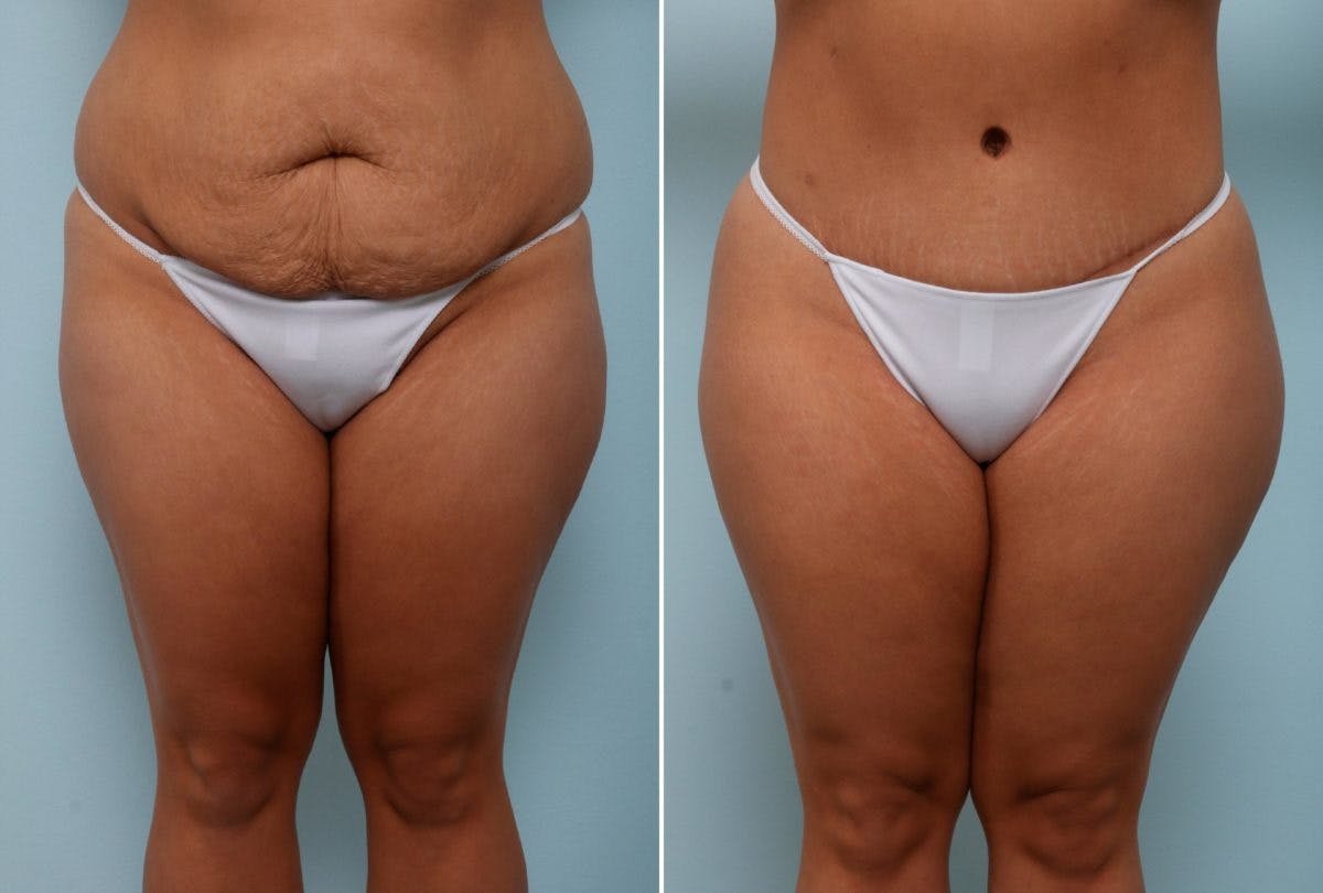 Body Lift Before & After Gallery - Patient 54881911 - Image 1