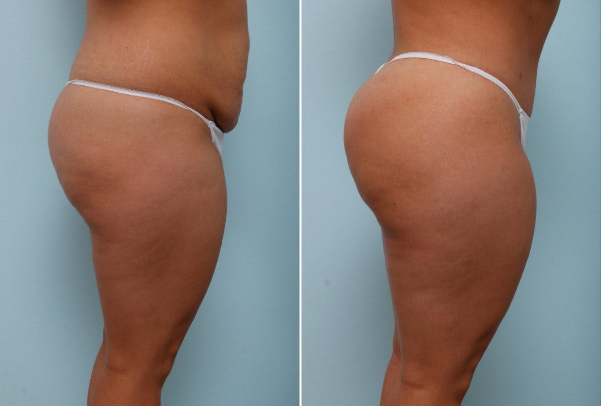 Body Lift Before & After Photo - Patient 54881911 - Image 2