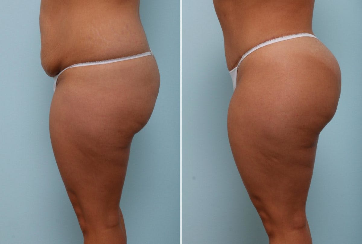 Body Lift Before & After Photo - Patient 54881911 - Image 3