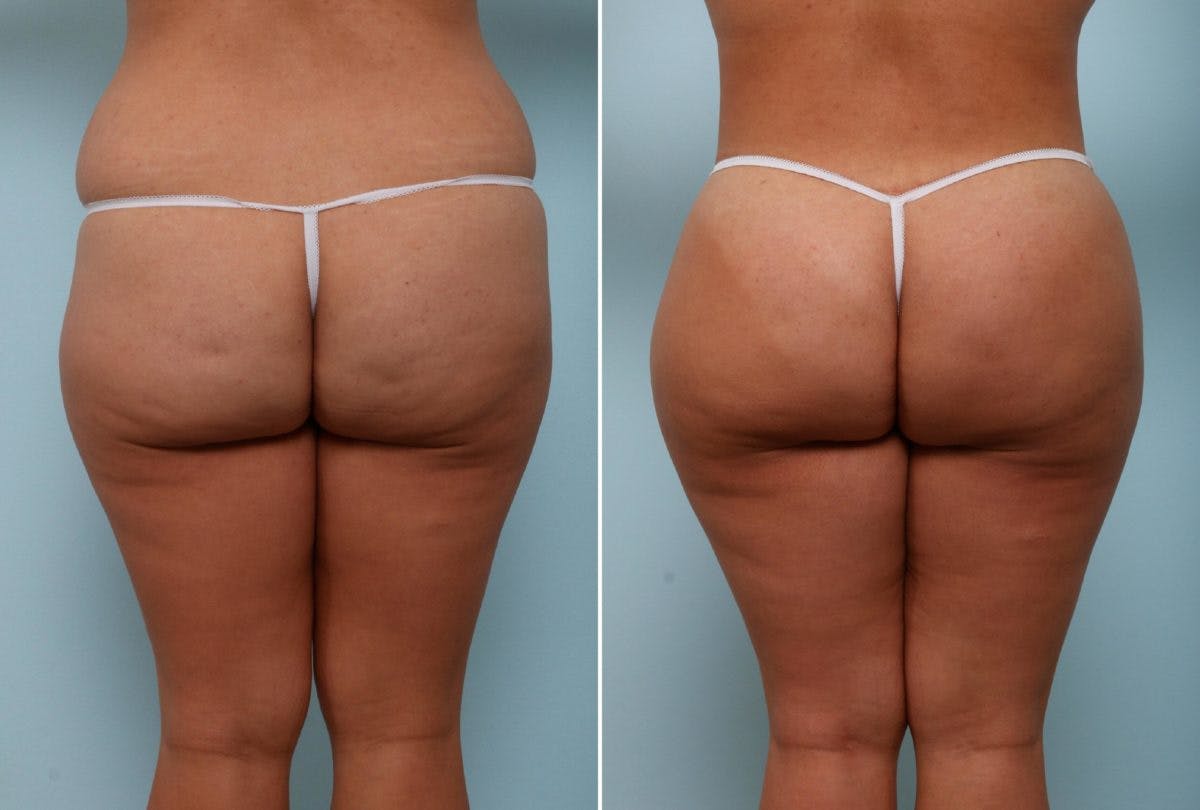 Body Lift Before & After Photo - Patient 54881911 - Image 4
