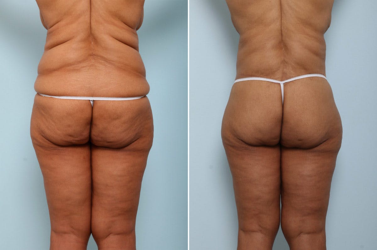 Body Lift Before & After Gallery - Patient 54881915 - Image 4