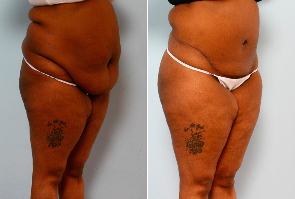 Body Lift Before & After Photo - Patient 54881917 - Image 2