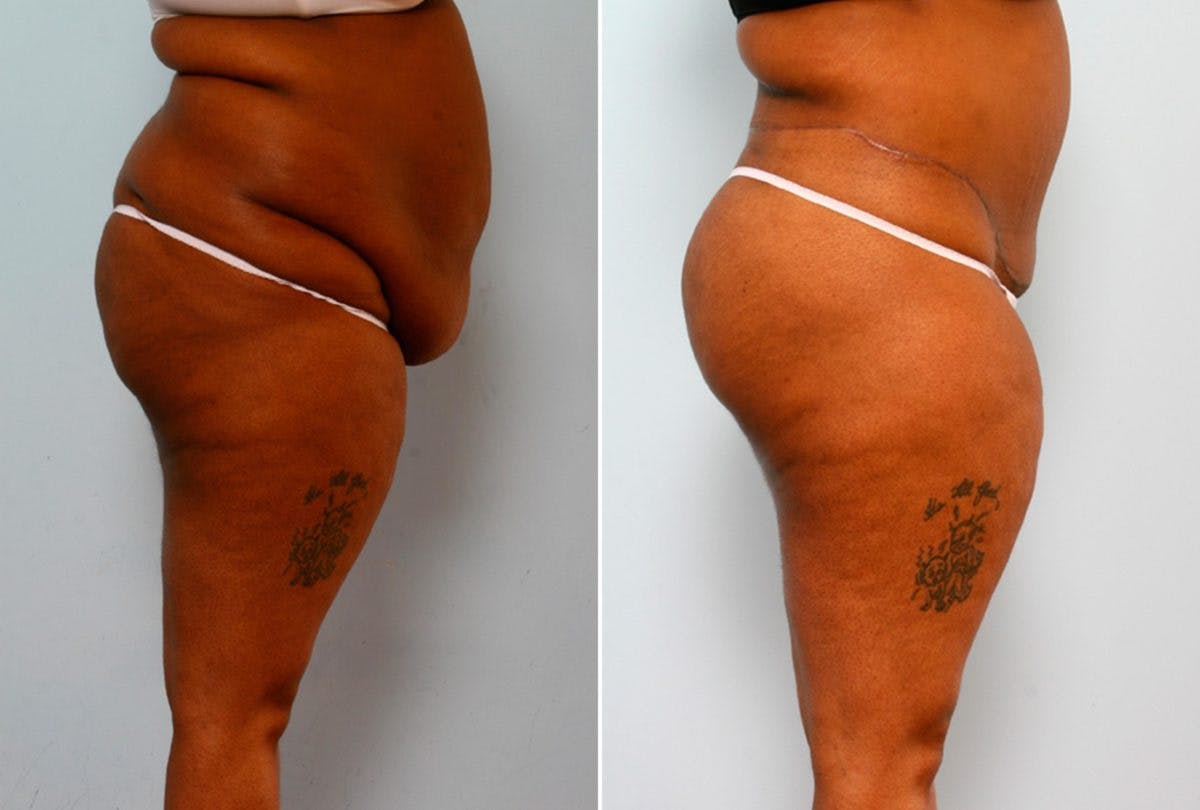 Body Lift Before & After Photo - Patient 54881917 - Image 3