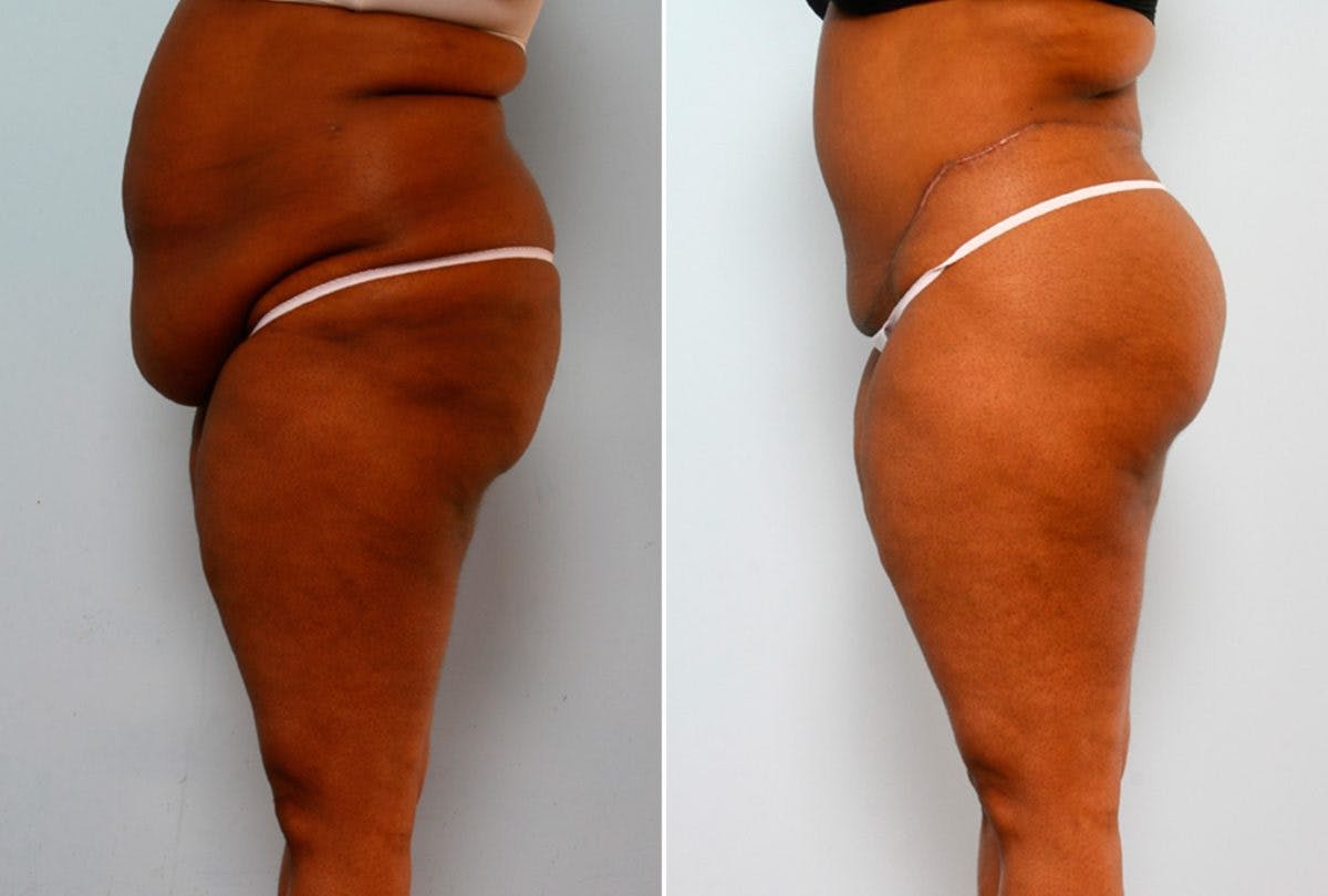 Body Lift Before & After Gallery - Patient 54881917 - Image 5