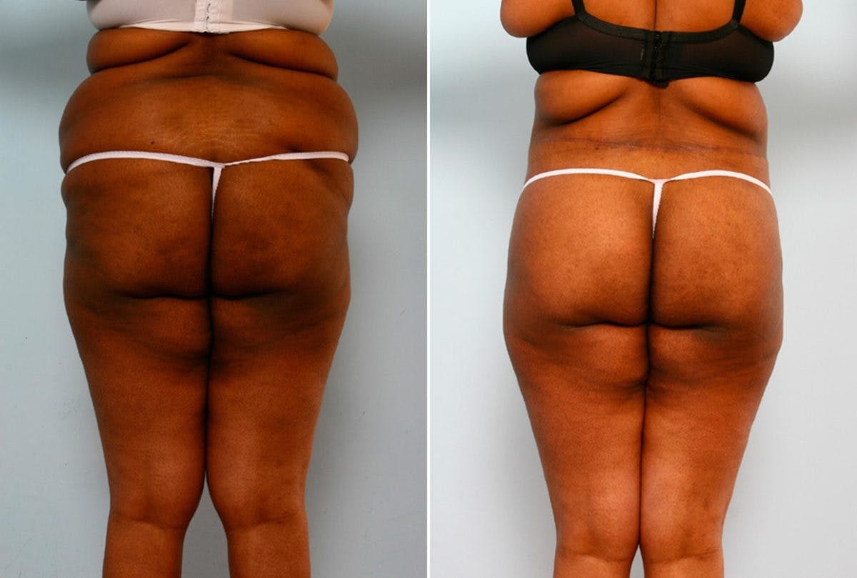 Body Lift Before & After Photo - Patient 54881917 - Image 6