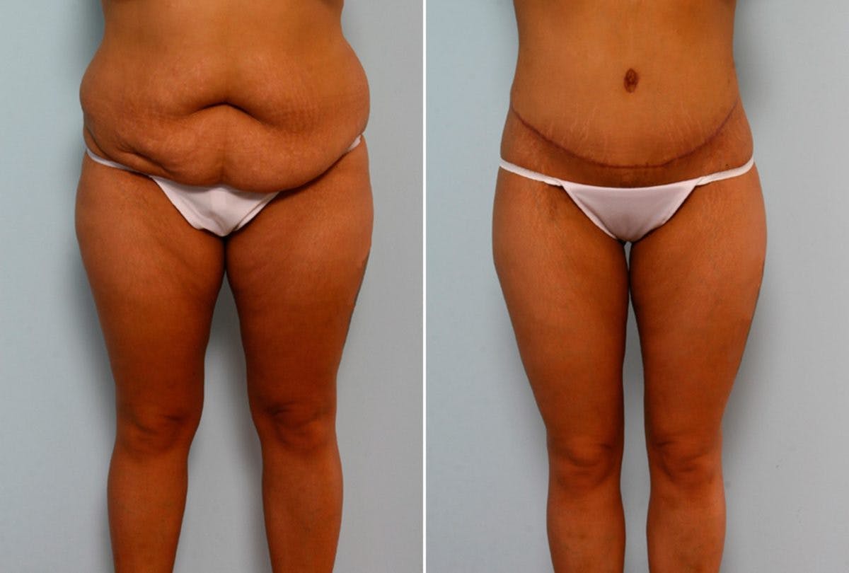 Body Lift Before & After Gallery - Patient 54881918 - Image 1