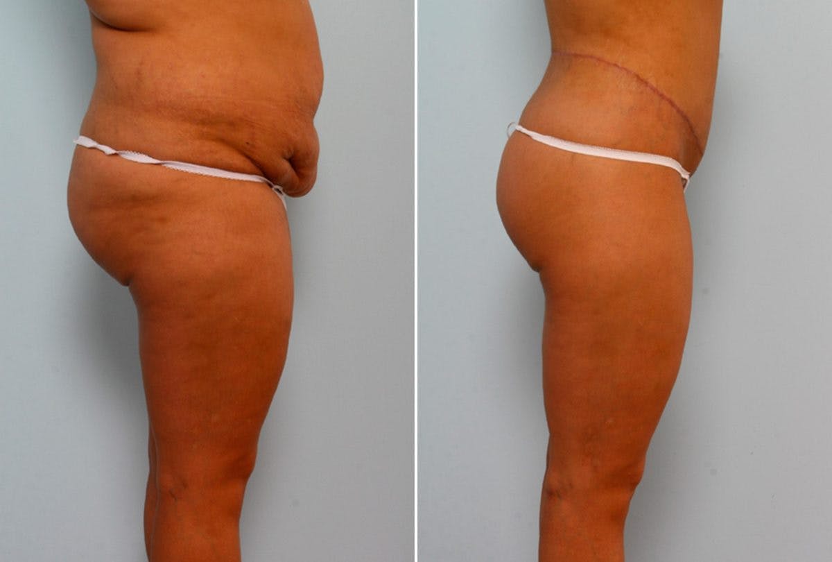 Body Lift Before & After Gallery - Patient 54881918 - Image 3