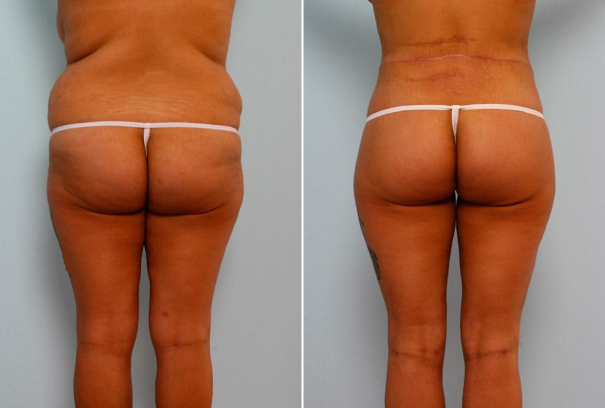 Body Lift Before & After Gallery - Patient 54881918 - Image 4