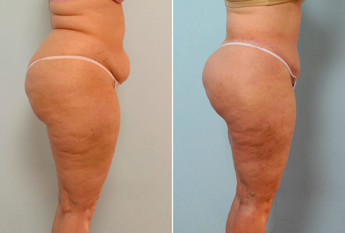 Body Lift Before & After Gallery - Patient 54881921 - Image 3