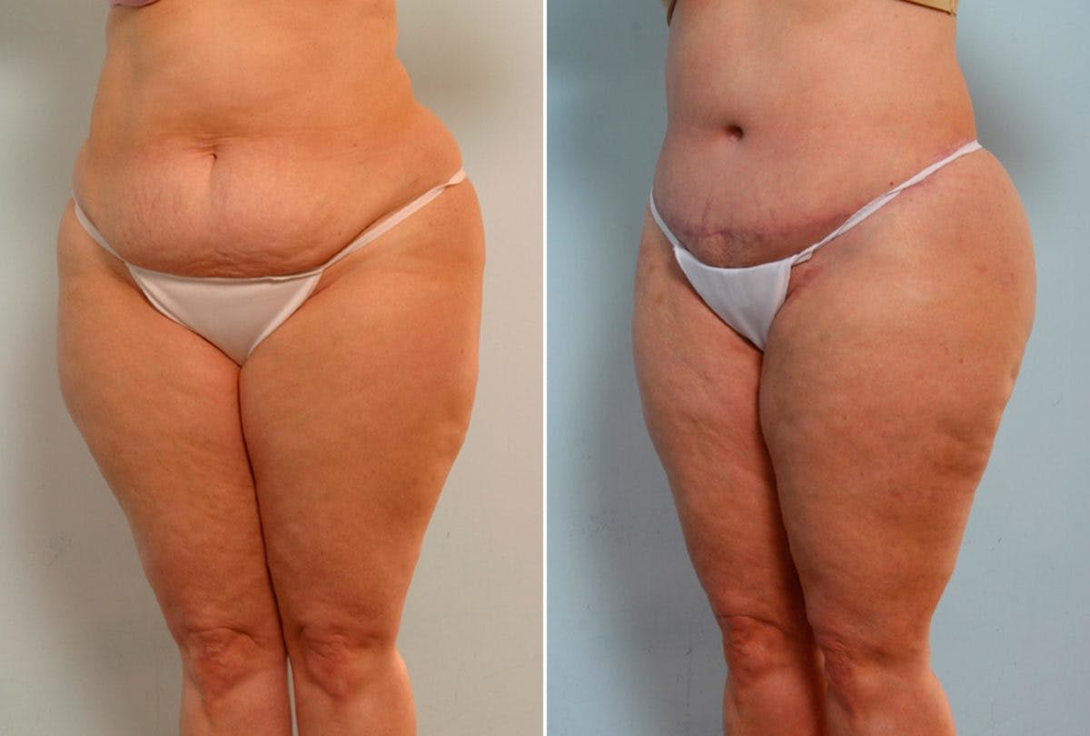 Body Lift Before & After Gallery - Patient 54881921 - Image 4