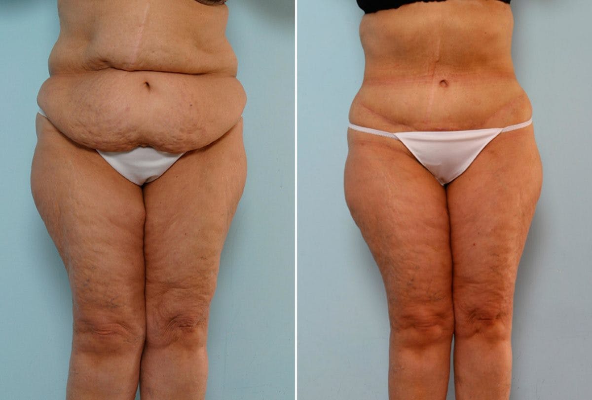 Body Lift Before & After Gallery - Patient 54881923 - Image 1