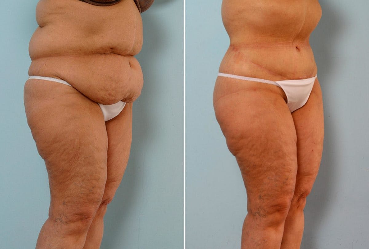 Body Lift Before & After Gallery - Patient 54881923 - Image 2