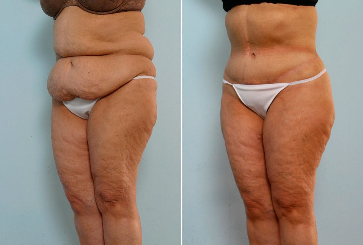 Body Lift Before & After Gallery - Patient 54881923 - Image 4
