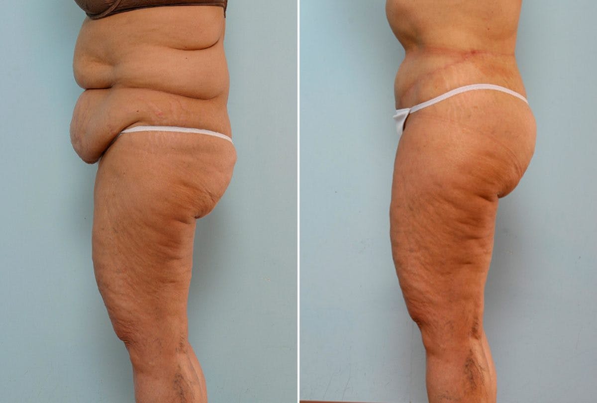 Body Lift Before & After Gallery - Patient 54881923 - Image 5