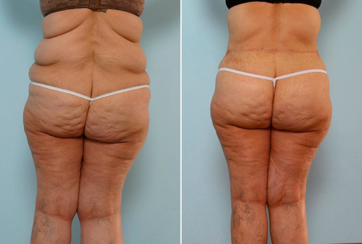Body Lift Before & After Photo - Patient 54881923 - Image 6