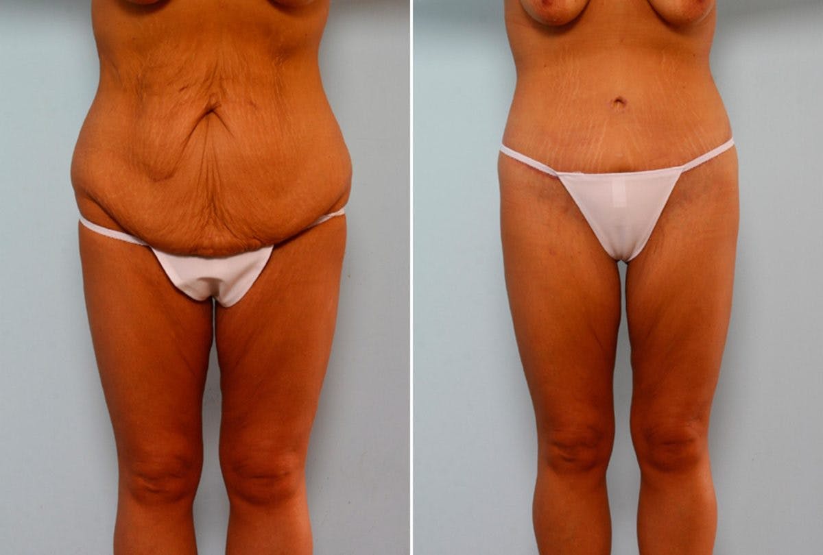 Body Lift Before & After Gallery - Patient 54881926 - Image 1