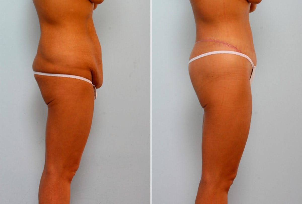 Body Lift Before & After Gallery - Patient 54881926 - Image 3