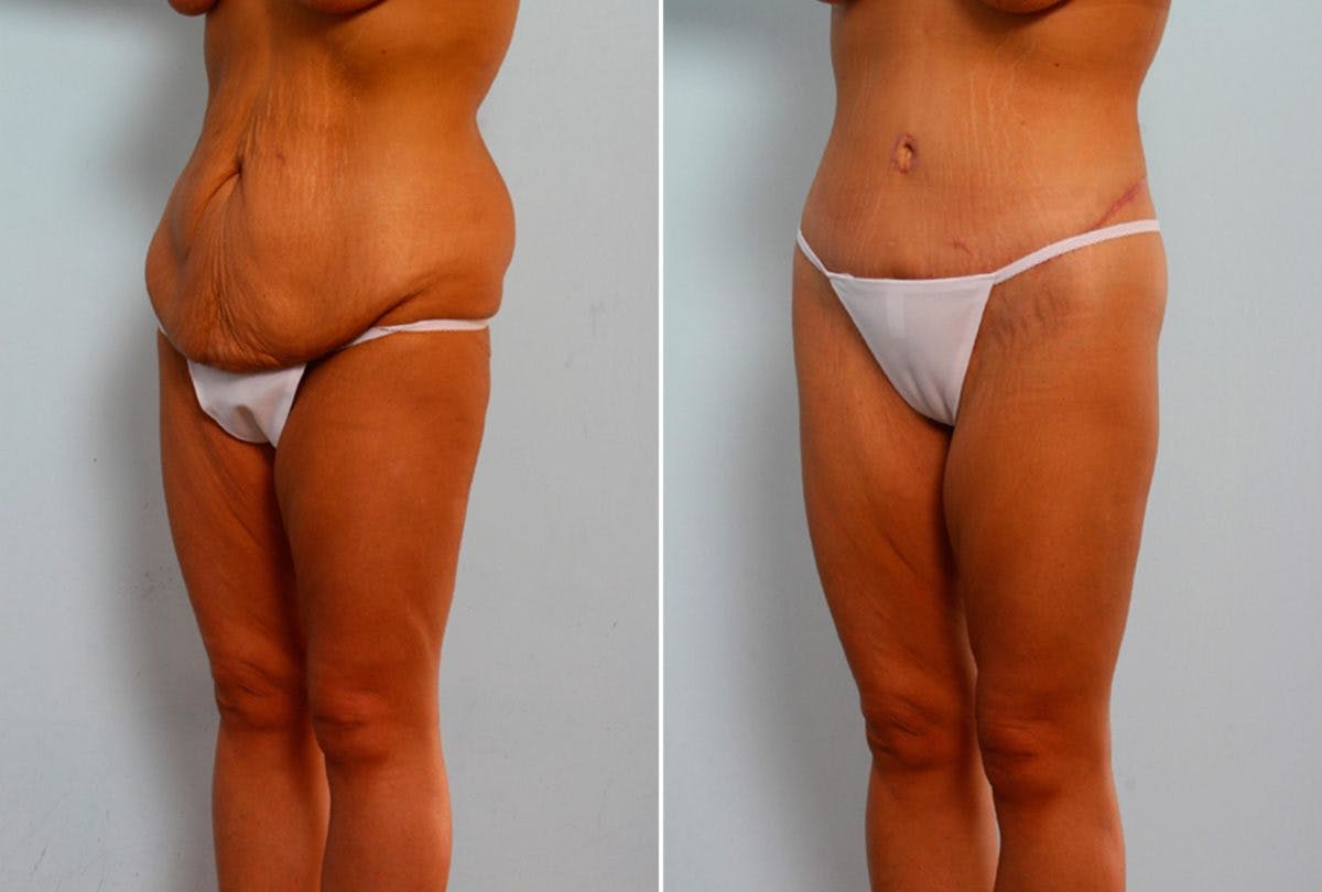 Body Lift Before & After Gallery - Patient 54881926 - Image 4