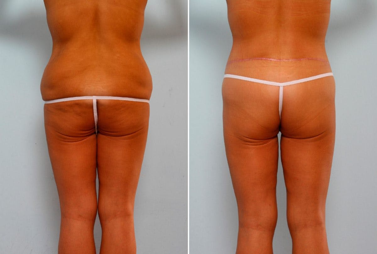 Body Lift Before & After Gallery - Patient 54881926 - Image 6